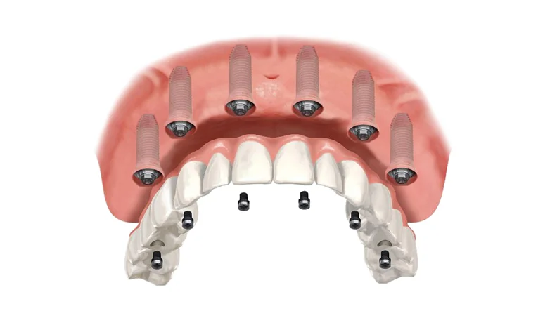 Имплантация зубов «All-on-6»